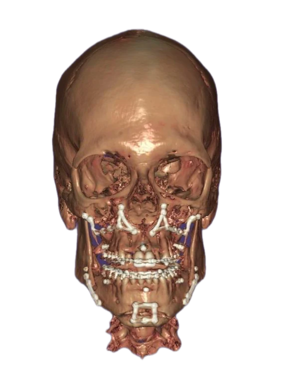 Front-facing 3D skull model showing fixation plates on the upper jaw, lower jaw and chin
