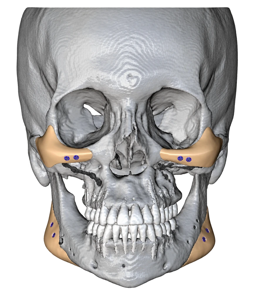 3D skull model showing custom implants at the cheekbones and jaw angles